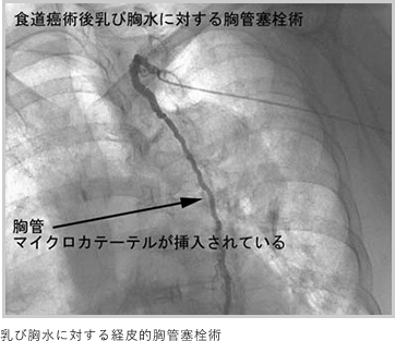 画像：乳び胸水に対する経皮的胸管塞栓術