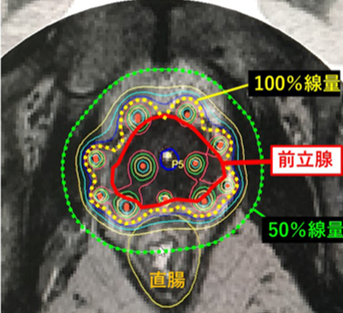 画像：前立腺がんの組織内照射