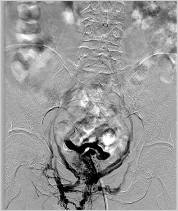 画像：直腸静脈瘤に対する治療